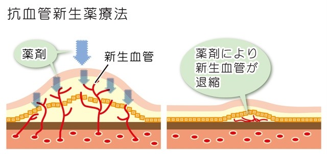 抗VEGF抗体の硝子体内注射について