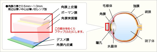 レーシックの仕組み